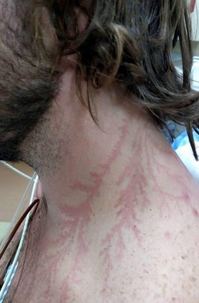 human struck by lightning scars